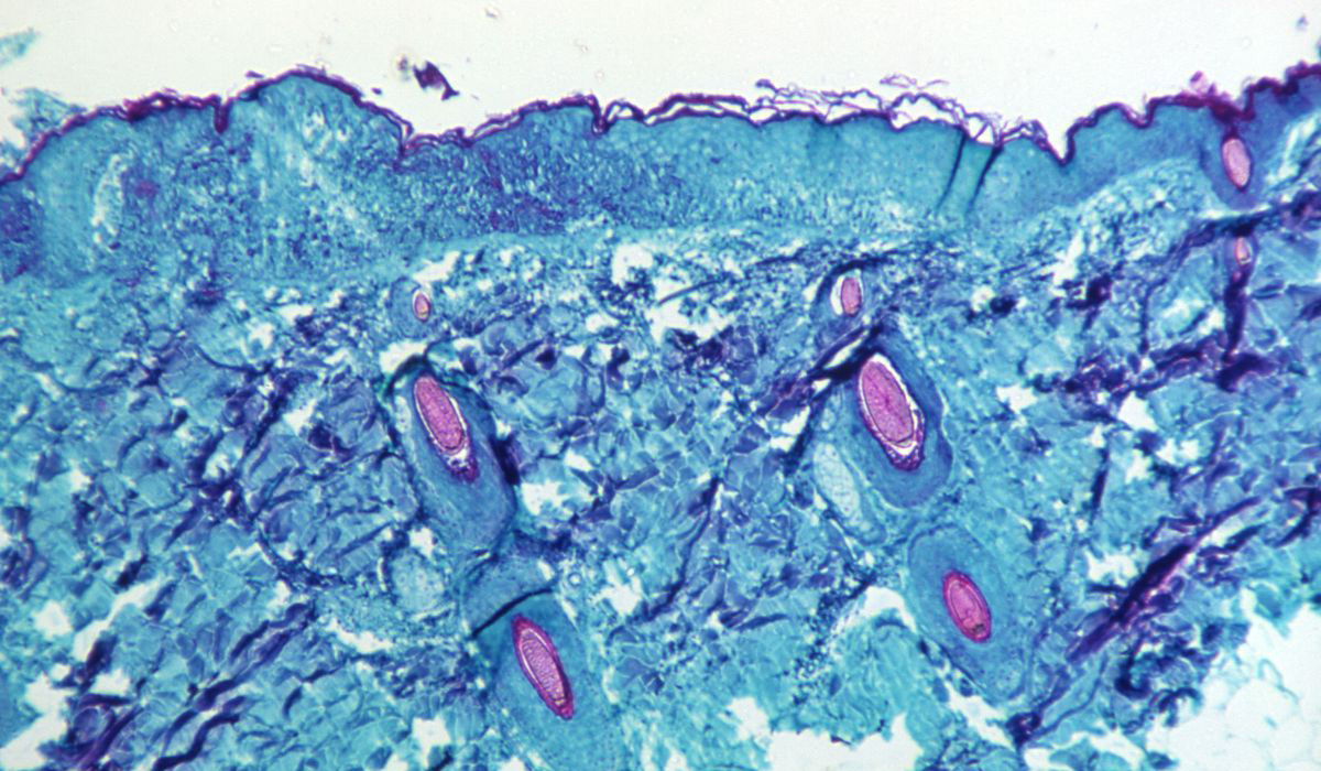Monkeypox virus